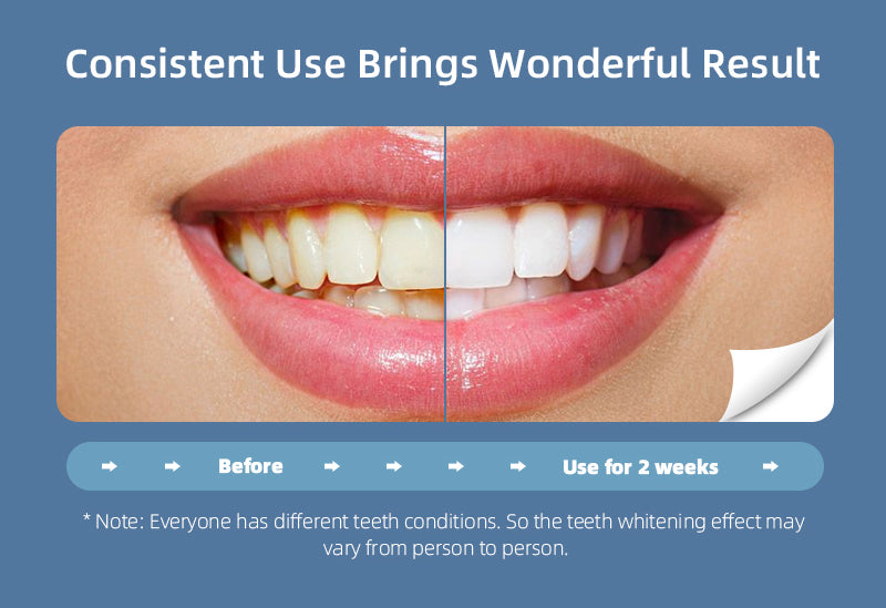 Illuminate Your Smile: Blue Light Teeth Whitening Device, Unleash a Professional Teeth - whitening Experience